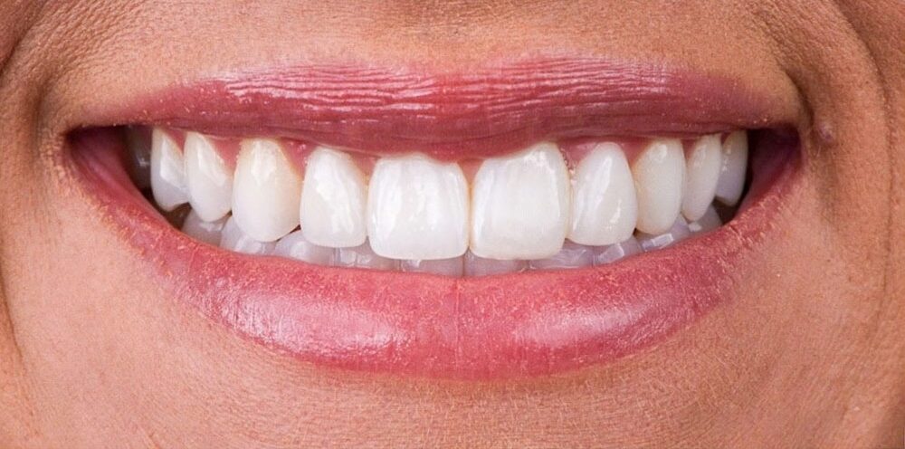 cosmetic-dentist-los-angeles-16-transformed-e1718263561384